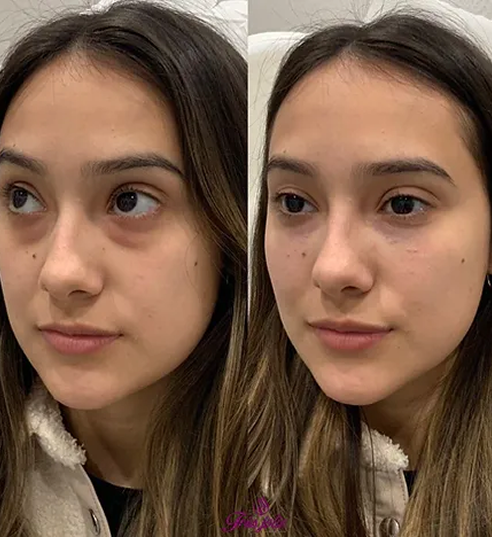 UnderEyes