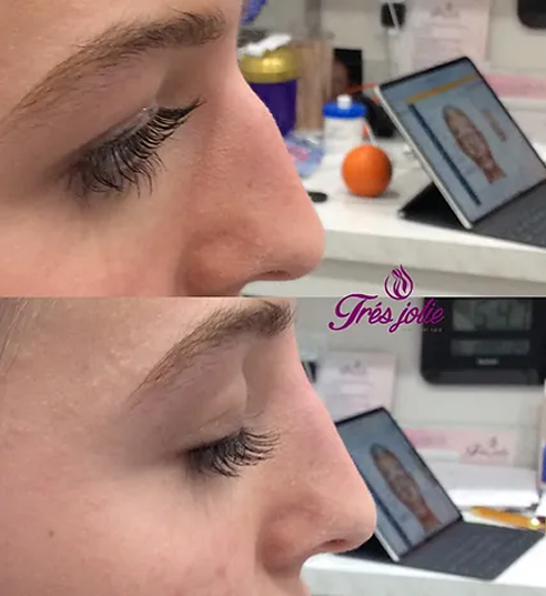 Liquid Nose Job