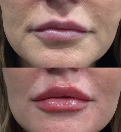 Lip Filler