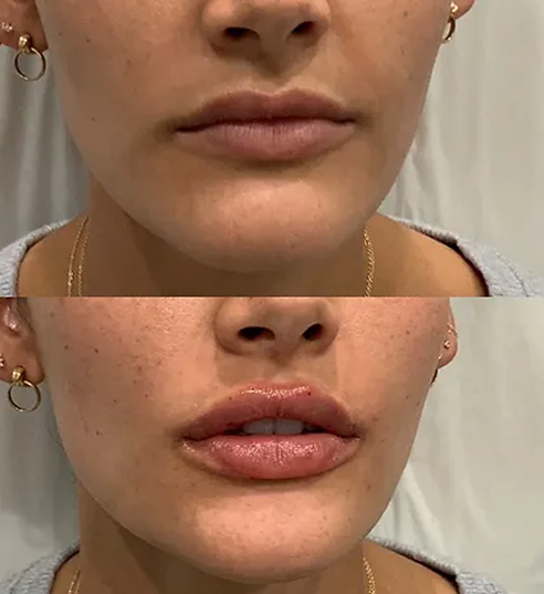 Lip Filler