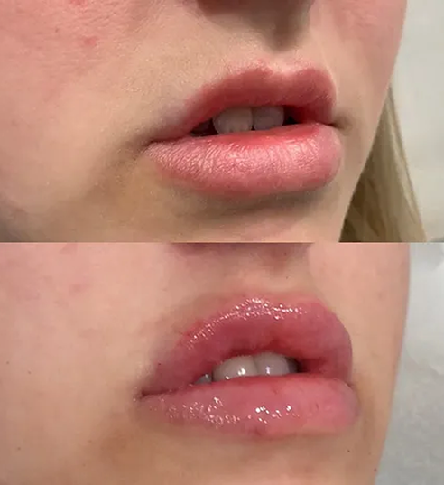 Lip Filler