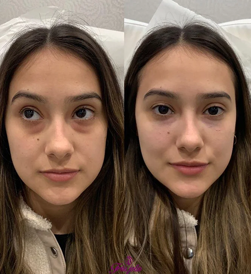 UnderEyes