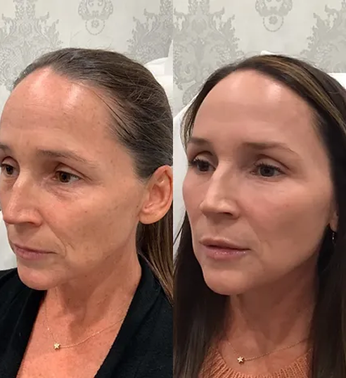 Full Face Treatment