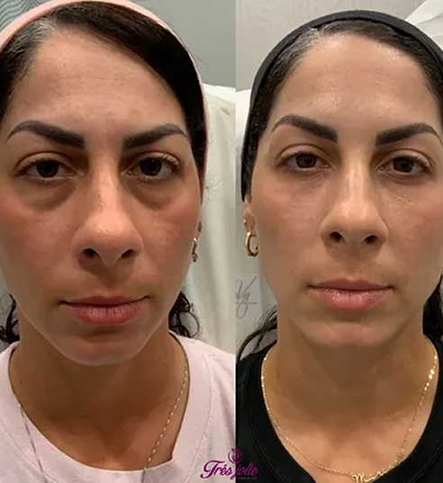 UnderEyes