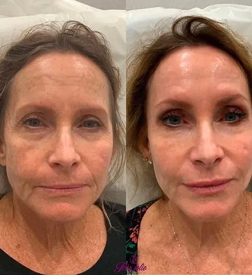 Full Face Treatment