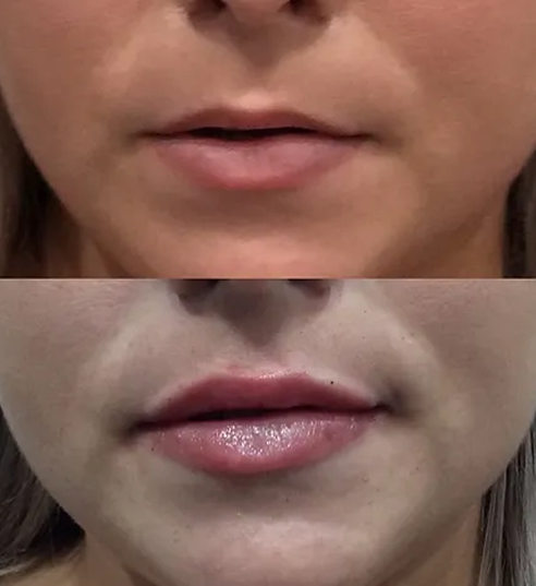 Lip FillerLip Filler