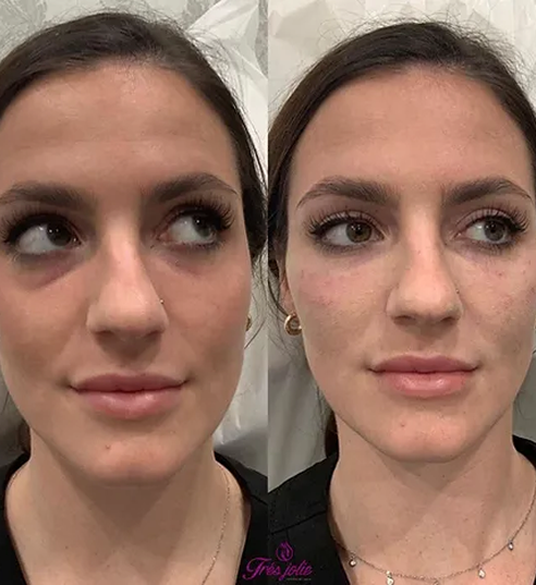 UnderEyes
