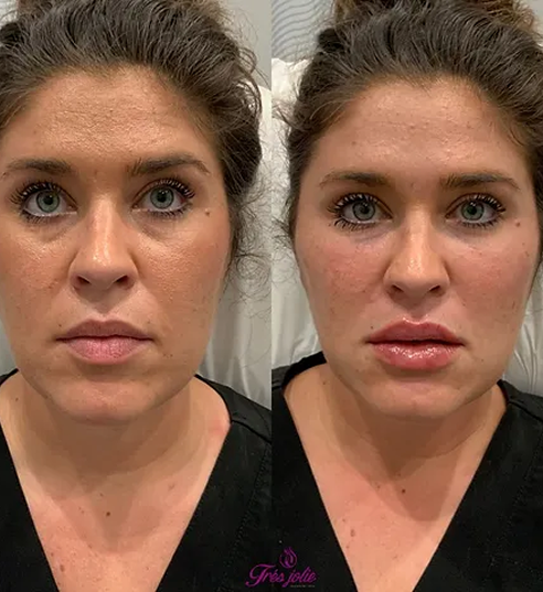 Full Face Treatment
