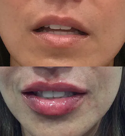 Lip Filler