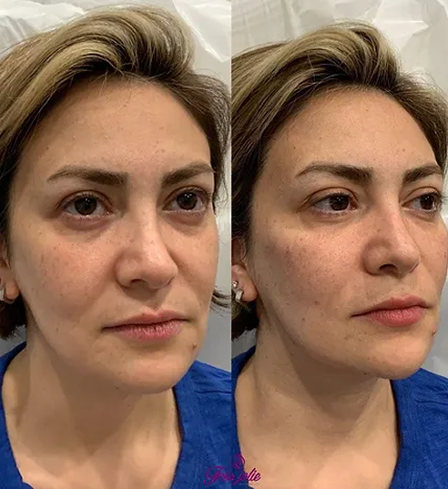 Full Face Treatment