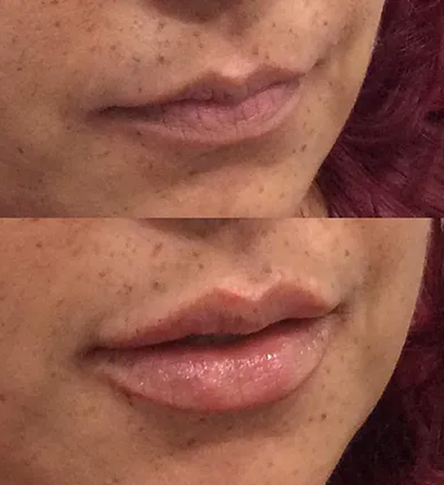 Lip Filler