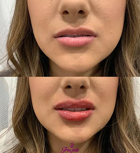 Lip Filler