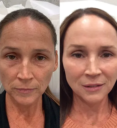 Full Face Treatment