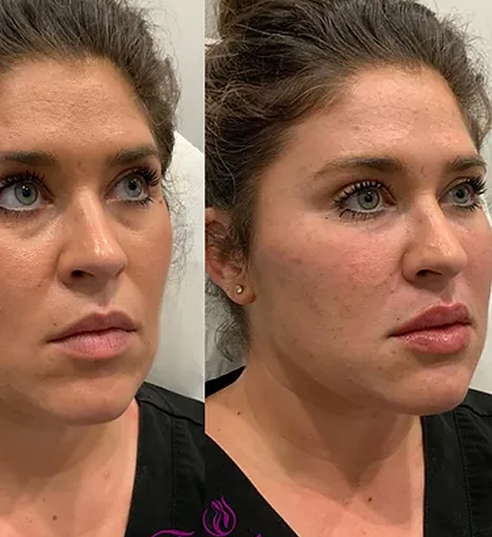 Lip Filler