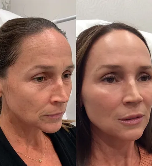 Full Face Treatment