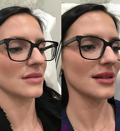 Lip Filler