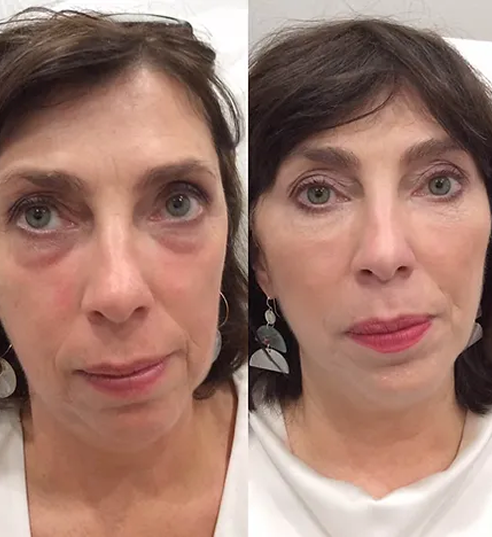 UnderEyes