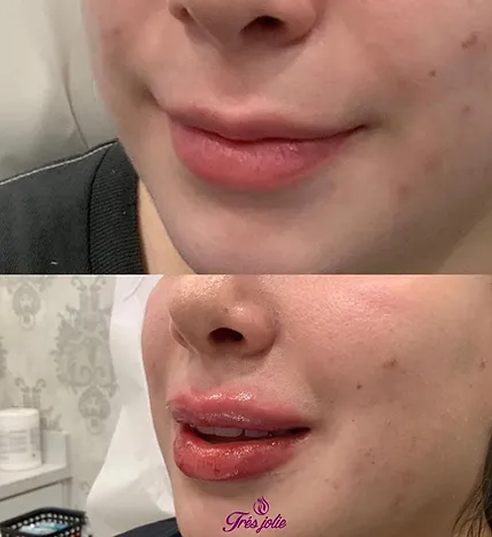 Lip Filler