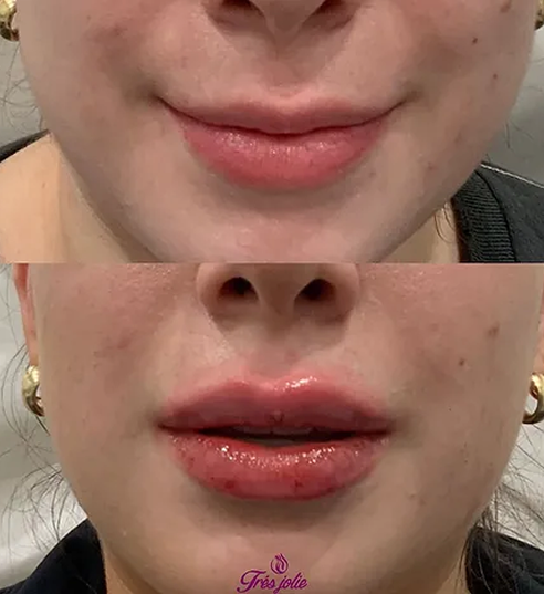 Lip Filler